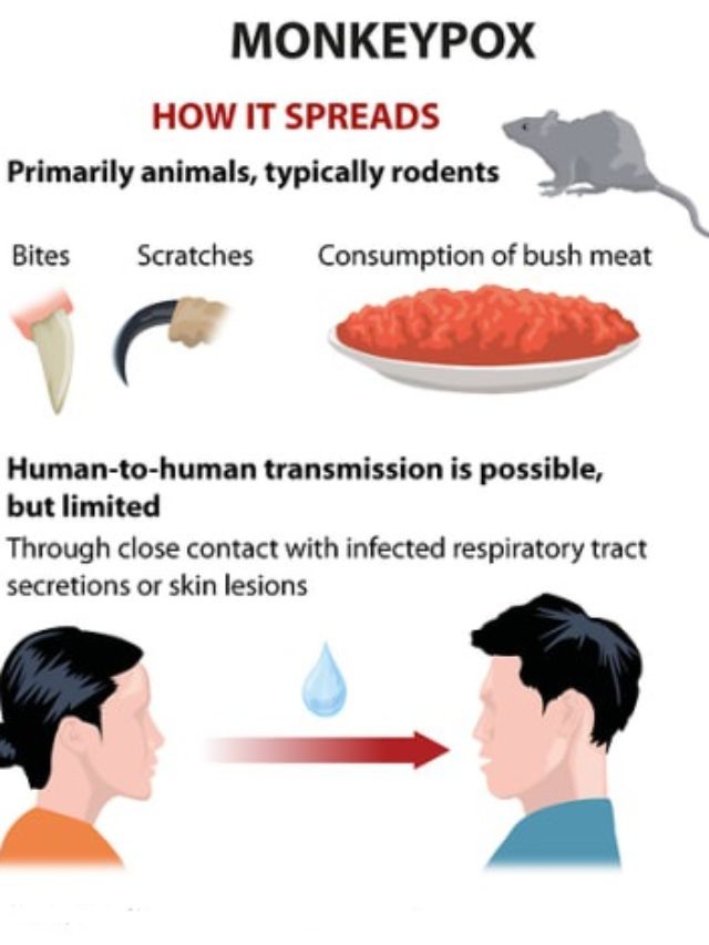 Monkeypox in India Symptoms & Treatment