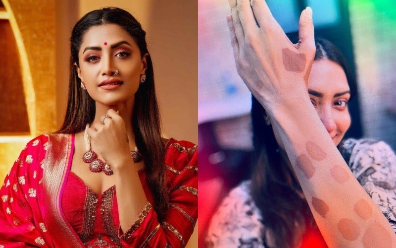 My body is 60% white. Vitiligo has no cure.  This is not a disease either